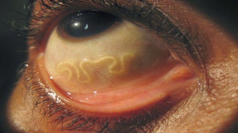 Parasite dans le globe oculaire humain