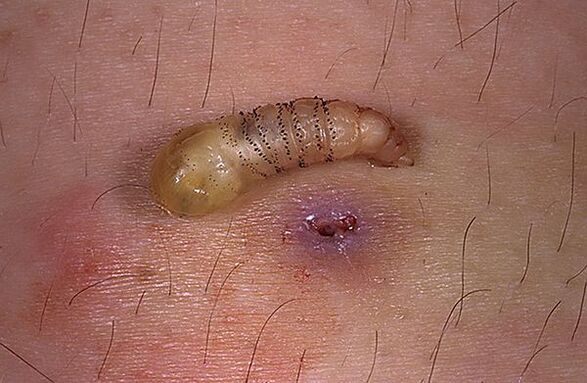 larve parasite sous-cutanée de l'homme