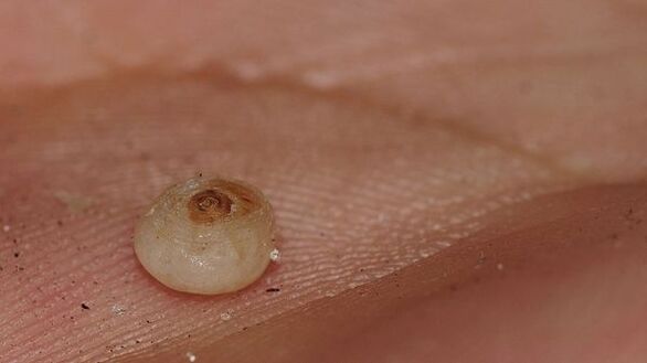 sarcopsillose avec parasites sous-cutanés